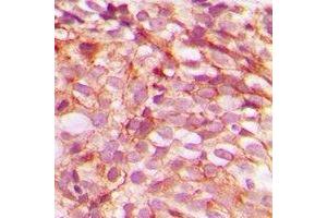 Immunohistochemical analysis of B-RAF (pS446) staining in human breast cancer formalin fixed paraffin embedded tissue section. (SNRPE antibody  (pSer446))