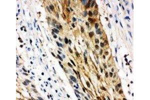 Anti-14-3-3 sigma antibody, IHC(P) IHC(P): Human Oesophagus Squama Cancer Tissue (14-3-3 sigma/SFN antibody  (Middle Region))