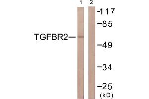 Immunohistochemistry analysis of paraffin-embedded human breast carcinoma tissue using CDC16/APC6 (Ab-560) antibody. (CDC16 antibody  (Ser560))