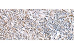 Immunohistochemistry of paraffin-embedded Human prost ate cancer tissue using RNF115 Polyclonal Antibody at dilution of 1:45(x200) (RNF115 antibody)