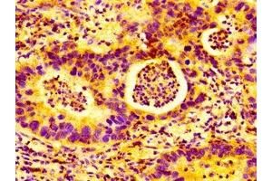 IHC image of ABIN7150978 diluted at 1:100 and staining in paraffin-embedded human bladder cancer performed on a Leica BondTM system. (AMFR antibody  (AA 485-643))