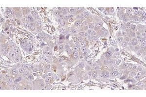 ABIN6272736 at 1/100 staining Human liver cancer tissue by IHC-P. (P2RY10 antibody  (Internal Region))