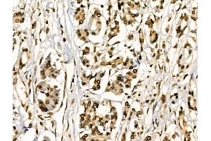ABIN6256421 and ABIN6267295 at 1/100 staining Human pancreatic cancer and adjacent nomal tissues by IHC-P. (HSP27 antibody  (pSer78))