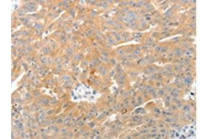 The image on the left is immunohistochemistry of paraffin-embedded Human ovarian cancer tissue using (TEP1 Antibody) at dilution 1/50, on the right is treated with synthetic peptide.
