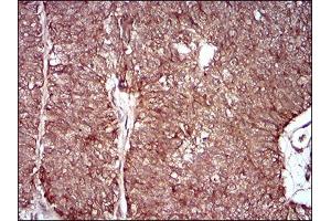 Immunohistochemical analysis of paraffin-embedded ovarian cancer tissues using MMEL1 mouse mAb with DAB staining. (MMEL1 antibody  (AA 1-107))