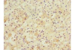 Immunohistochemistry of paraffin-embedded human liver cancer using ABIN7165942 at dilution of 1:100 (PPM1D antibody  (AA 1-250))