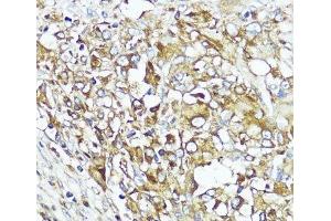 Immunohistochemistry of paraffin-embedded Human liver cancer using MLKL Polyclonal Antibody at dilution of 1:200 (40x lens). (MLKL antibody)