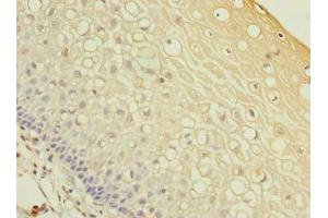 Immunohistochemistry of paraffin-embedded human cervical cancer using ABIN7142427 at dilution of 1:100
