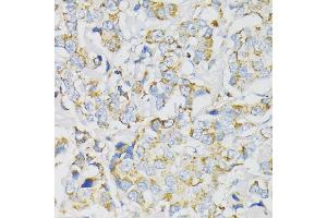 Immunohistochemistry of paraffin-embedded human breast cancer using J antibody (ABIN1678787, ABIN3018048, ABIN3018049 and ABIN6220343) at dilution of 1:100 (40x lens). (ATP5J antibody  (AA 1-108))