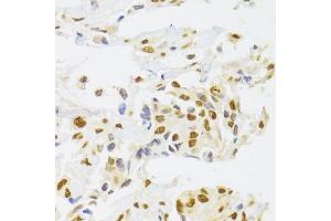 Immunohistochemistry of paraffin-embedded human breast cancer using hnRNP  Antibody (ABIN6128029, ABIN6141896, ABIN6141899 and ABIN6223388) at dilution of 1:100 (40x lens). (HNRNPA1 antibody  (AA 1-372))
