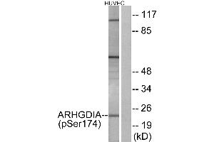 Immunohistochemistry analysis of paraffin-embedded human cervix carcinoma tissue using ARHGDIA (Phospho-Ser174) antibody.