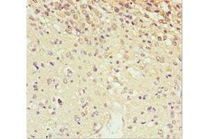 Immunohistochemistry of paraffin-embedded human glioma using ABIN7168663 at dilution of 1:100 (SCRN2 antibody  (AA 176-425))
