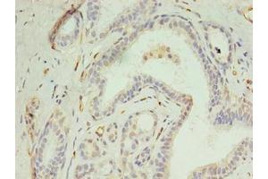 Immunohistochemistry of paraffin-embedded human breast cancer using ABIN7150021 at dilution of 1:100 (DIP2A antibody  (AA 1-300))