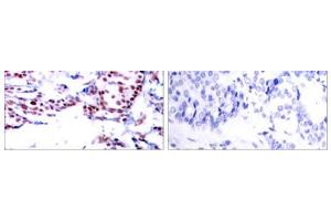 Immunohistochemical analysis of paraffin- embedded human breast carcinoma tissue using ATF-2 (Ab-71or 53) antibody (E021031). (ATF2 antibody)