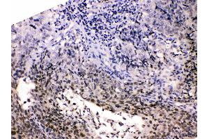 HDGF was detected in paraffin-embedded sections of human lung cancer tissues using rabbit anti- HDGF Antigen Affinity purified polyclonal antibody (Catalog # ) at 1 µg/mL. (HDGF antibody  (C-Term))