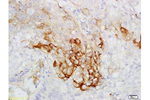 Formalin-fixed and paraffin embedded human esophageal carcinoma labeled with Rabbit Anti-CK7 Polyclonal Antibody, Unconjugated  at 1:200 followed by conjugation to the secondary antibody and DAB staining (Cytokeratin 7 antibody  (AA 251-350))