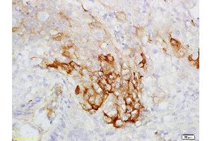 Formalin-fixed and paraffin embedded human esophageal carcinoma labeled with Rabbit Anti-CK7 Polyclonal Antibody, Unconjugated  at 1:200 followed by conjugation to the secondary antibody and DAB staining (Cytokeratin 7 antibody  (AA 251-350))
