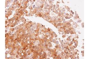 IHC-P Image Immunohistochemical analysis of paraffin-embedded PLC xenograft, using NQO2, antibody at 1:100 dilution. (NQO2 antibody  (Center))