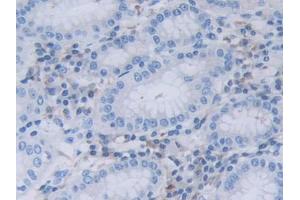 DAB staining on IHC-P; Samples: Human Stomach cancer Tissue (RNASEL antibody  (AA 358-583))