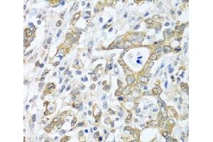 Immunohistochemistry of paraffin-embedded Human gastric cancer using TICAM1 Polyclonal Antibody at dilution of 1:100 (40x lens).