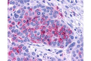 Anti-ADCYAP1R1 / PAC1 Receptor antibody IHC of human Ovary, Carcinoma. (ADCYAP1R1 antibody  (C-Term))