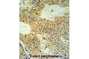 CLDN23 Antibody (C-term) IHC analysis in formalin fixed and paraffin embedded colon carcinoma followed by peroxidase conjugation of the secondary antibody and DAB staining. (Claudin 23 antibody  (C-Term))