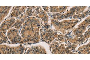 Immunohistochemistry of paraffin-embedded Human breast cancer tissue using CTNNBIP1 Polyclonal Antibody at dilution 1:30 (CTNNBIP1 antibody)