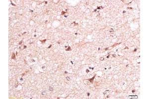 Formalin-fixed and paraffin embedded human brain glioma labeled with Anti-Torc1 (Ser151) Polyclonal Antibody, Unconjugated  at 1:200 followed by conjugation to the secondary antibody and DAB staining. (CRTC1 antibody  (pSer151))