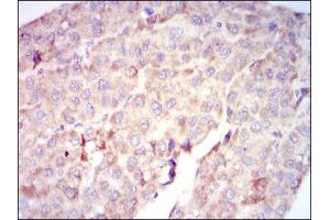 Immunohistochemical analysis of paraffin-embedded liver cancer tissues using RAF1 mouse mAb with DAB staining. (RAF1 antibody)