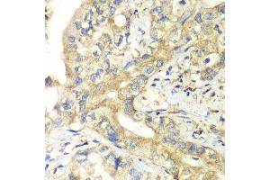 Immunohistochemistry of paraffin-embedded human liver cancer using TIMM17A antibody at dilution of 1:100 (x40 lens). (TIMM17A antibody)