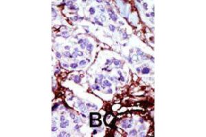 Formalin-fixed and paraffin-embedded human cancer tissue reacted with CMPK1 polyclonal antibody  , which was peroxidase-conjugated to the secondary antibody, followed by AEC staining. (Cytidine Monophosphate (UMP-CMP) Kinase 1, Cytosolic (CMPK1) (C-Term) antibody)