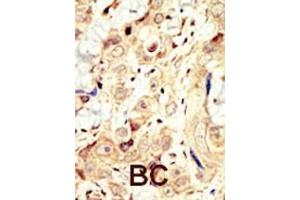 Formalin-fixed and paraffin-embedded human cancer tissue reacted with the primary antibody, which was peroxidase-conjugated to the secondary antibody, followed by DAB staining. (ERBB4 antibody  (N-Term))