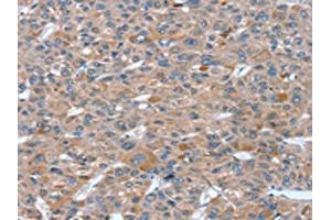 The image on the left is immunohistochemistry of paraffin-embedded Human liver cancer tissue using ABIN7130819(RASAL1 Antibody) at dilution 1/20, on the right is treated with fusion protein. (RASAL1 antibody)