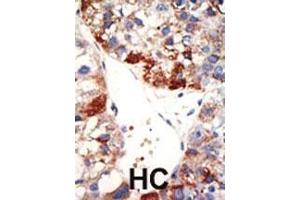 Formalin-fixed and paraffin-embedded human cancer tissue reacted with the primary antibody, which was peroxidase-conjugated to the secondary antibody, followed by DAB staining. (NUB1 antibody  (N-Term))