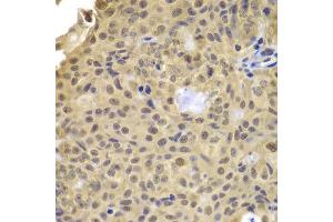 Immunohistochemistry of paraffin-embedded human well-differentiated squamous skin carcinoma using CCNA2 antibody at dilution of 1:100 (x400 lens).