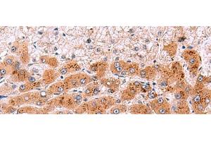 Immunohistochemistry of paraffin-embedded Human liver cancer tissue using NCAN Polyclonal Antibody at dilution of 1:30(x200) (Neurocan antibody)