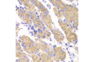 Immunohistochemistry of paraffin-embedded human stomach cancer using SMYD4 antibody at dilution of 1:100 (x40 lens). (SMYD4 antibody)