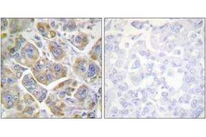Immunohistochemistry analysis of paraffin-embedded human breast carcinoma tissue, using Integrin beta4 (Ab-1510) Antibody. (Integrin beta 4 antibody  (AA 1481-1530))