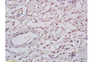 Formalin-fixed and paraffin embedded human cervical carcinoma labeled with Anti-Nogo A+B Polyclonal Antibody, Unconjugated  at 1:200 followed by conjugation to the secondary antibody and DAB staining (Reticulon 4 antibody  (AA 251-357))
