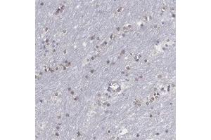 Immunohistochemical staining (Formalin-fixed paraffin-embedded sections) of human lateral ventricle with SOX11 polyclonal antibody  shows nuclear positivity in glial cells at 1:200 - 1:500 dilution. (SOX11 antibody)