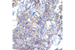 Immunohistochemistry of paraffin-embedded human lung cancer using Talin 2 Rabbit mAb (ABIN7270720) at dilution of 1:100 (40x lens). (TLN2 antibody)