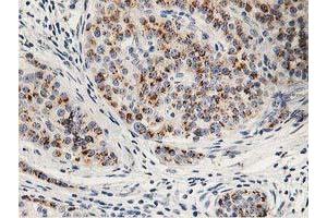 Immunohistochemical staining of paraffin-embedded Carcinoma of Human pancreas tissue using anti-HOXC11 mouse monoclonal antibody.