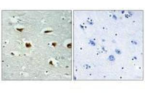 Immunohistochemical analysis of paraffin-embedded human colon carcinoma tissue using 4E-BP1 (Ab-69) antibody. (eIF4EBP1 antibody  (Thr70))