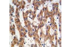 IHC analysis of FFPE human hepatocarcinoma tissue stained with PHB antibody (Prohibitin antibody  (AA 89-117))