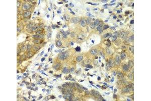 Immunohistochemistry of paraffin-embedded Human gastric cancer using DPP3 Polyclonal Antibody at dilution of 1:100 (40x lens). (DPP3 antibody)