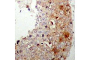 Immunohistochemical analysis of XIAP (pS87) staining in human prostate cancer formalin fixed paraffin embedded tissue section.