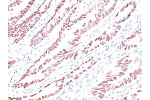 Formalin-fixed, paraffin-embedded human Colon Carcinoma stained with p57 Monoclonal Antibody (KP10). (CDKN1C antibody)