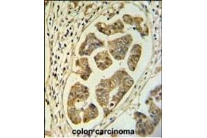 HCCS Antibody (Center) (ABIN653839 and ABIN2843103) IHC analysis in formalin fixed and paraffin embedded colon carcinoma followed by peroxidase conjugation of the secondary antibody and DAB staining. (HCCS antibody  (AA 173-200))