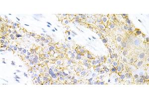 Immunohistochemistry of paraffin-embedded Human esophageal cancer using PPP2R4 Polyclonal Antibody at dilution of 1:200 (40x lens). (PPP2R4 antibody)