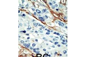 Formalin-fixed and paraffin-embedded human cancer tissue reacted with the primary antibody, which was peroxidase-conjugated to the secondary antibody, followed by DAB staining. (NUAK1 antibody  (C-Term))